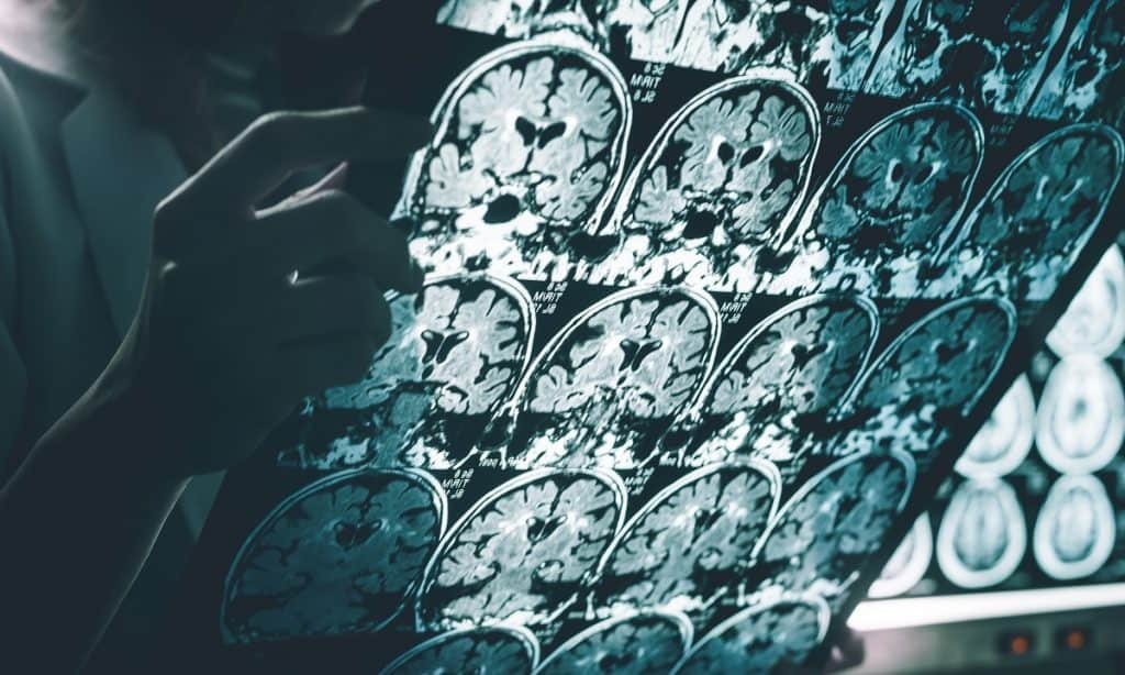 Novo estudo revela como o Alzheimer começa no cérebro